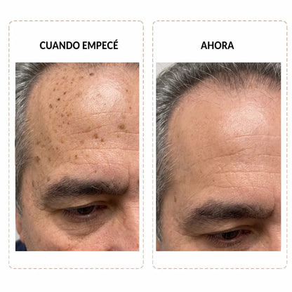 Deja la batalla diaria con tus verrugas y elimínalas sin tratamientos costosos ni dolorosos con Keralis™
