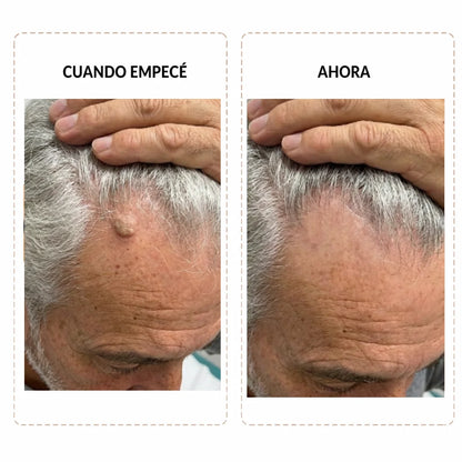 Deja la batalla diaria con tus verrugas y elimínalas sin tratamientos costosos ni dolorosos con Keralis™